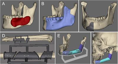 Virtual surgical planning/3D printing assisted fibula osteoseptocutaneous flap combined with anterolateral thigh flaps for extensive composite oromandibular defects reconstruction: a retrospective study of case series